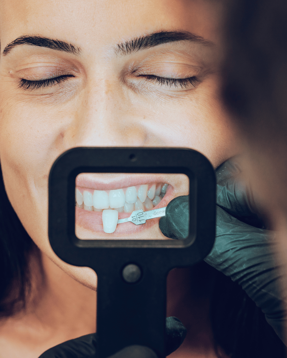 Faccette dentali Treviso
